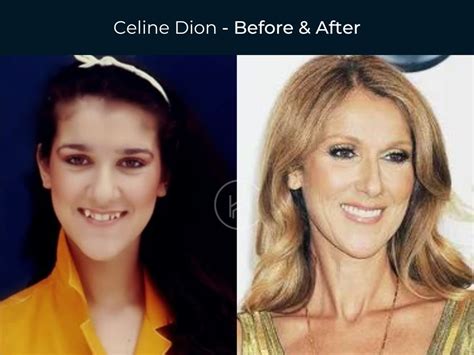 celine teeth|celine dion before and after.